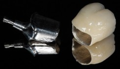 Metall oder Vollkeramik?