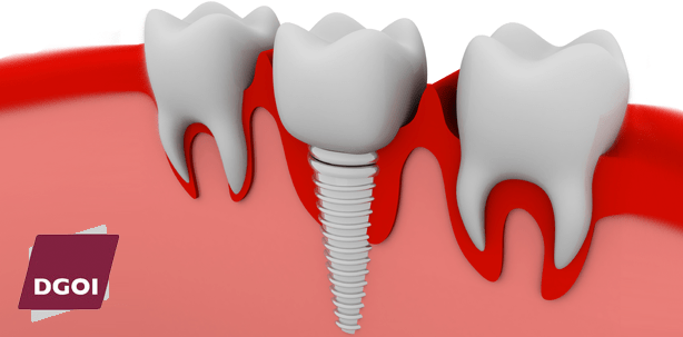 Fortbildung: Metallfreie Implantologie