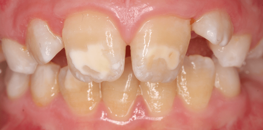 Ätiologie und Therapie von MIH-Zähnen