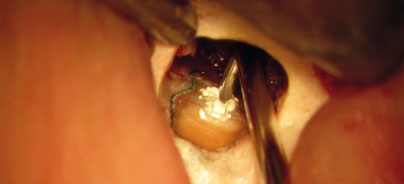 Die endodontische Mikrochirurgie der apikalen Läsion