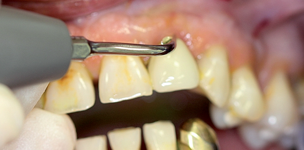 (Ultraschall-)Instrumente: Gründliche Entfernung der Mikroorganismen