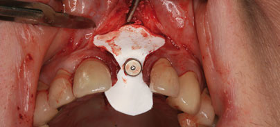 Mikrochirurgie und GBR in der Implantologie