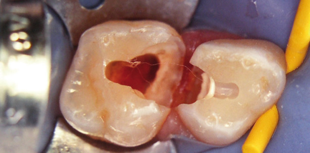 Milchzahnendodontie: „State of the Art“