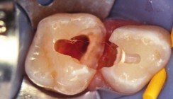 Milchzahnendodontie: „State of the Art“