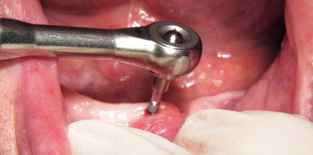 Primärstabilität von Mini-Implantaten ermöglicht Sofortbelastung