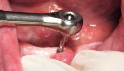 Primärstabilität von Mini-Implantaten ermöglicht Sofortbelastung