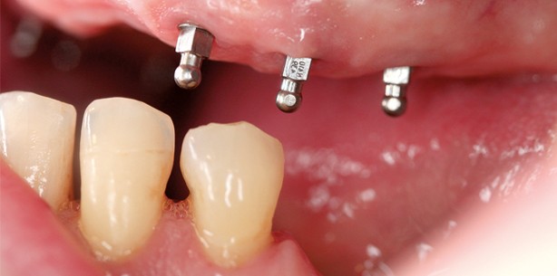 Verankerung einer Totalprothese mit Mini-Implantaten