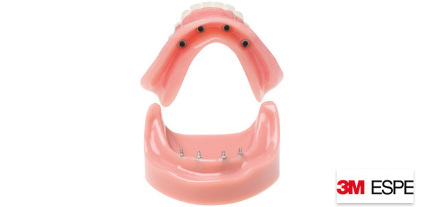 Erfolgskonzept Mini-Implantate