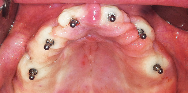 Mini-Implantate: Eine adäquate Therapieoption für Senioren