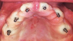 Mini-Implantate: Eine adäquate Therapieoption für Senioren