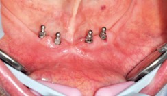 Mini-Implantate: Eine sinnvolle Ergänzung zu konventionellen Implantaten?!