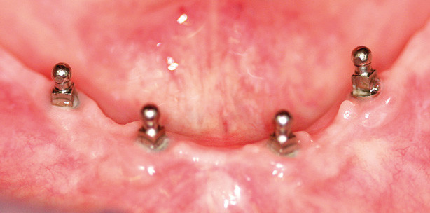 Mini-Implantate – die Lösung für ­anamnestisch vorbelastete Patienten