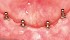Mini-Implantate – die Lösung für anamnestisch vorbelastete Patienten