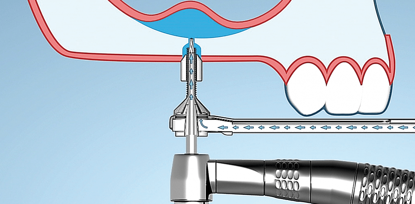 Minimalinvasiver Sinuslift mit hohem hydraulischen Druck