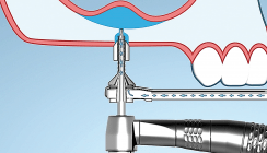 Minimalinvasiver Sinuslift mit hohem hydraulischen Druck