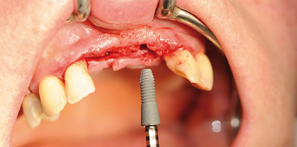 Minimalinvasive Implantologie – Ein Überblick und Erfahrungsbericht