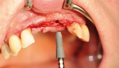 Minimalinvasive Implantologie – Ein Überblick und Erfahrungsbericht