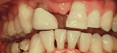 Ozonanwendung in der Parodontologie