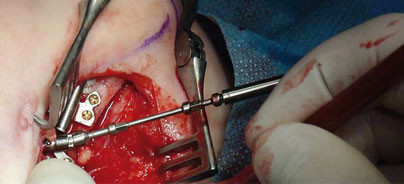 Distraktion in der Oralchirurgie und Mund-, Kiefer- und Gesichtschirurgie