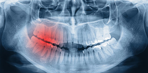 MKG-Chirurgie zwischen Implantologie und Tumorchirurgie