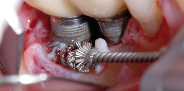 Die moderne Periimplantitisbehandlung