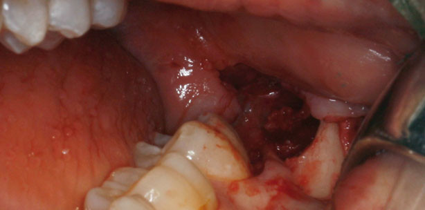 Singuläre Vertikalinzision bei der ­Entfernung unterer dritter Molaren