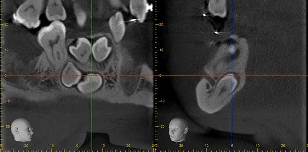 DVT – (k)eine Frage der Dosis?