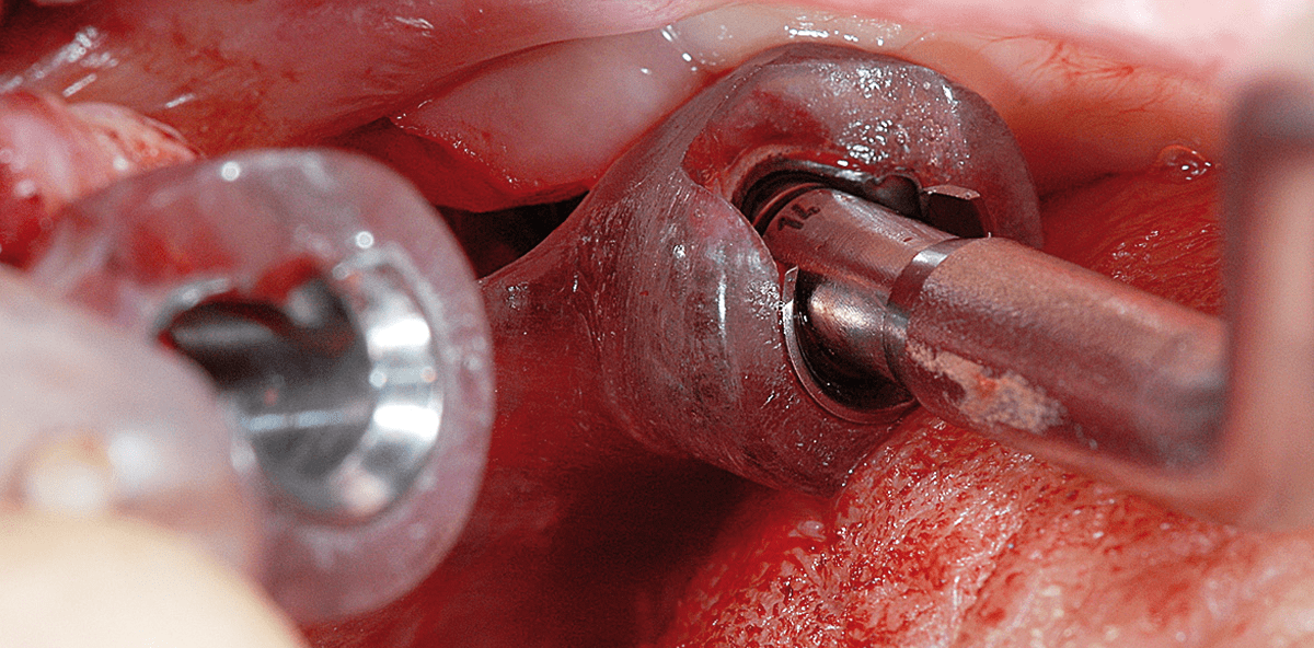 Konfektionierte Verbindungs­elemente zur Verankerung von Zahnprothesen auf Implantaten