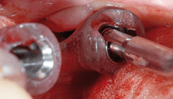 Konfektionierte Verbindungselemente zur Verankerung von Zahnprothesen auf Implantaten