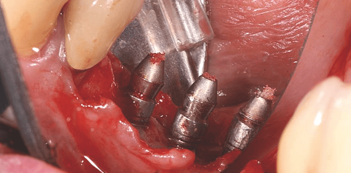 Mukositis und Periimplantitis
