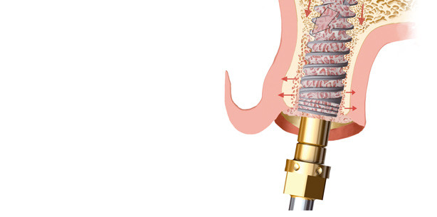 Implantieren im atrophierten Kiefer ohne Knochenabbau und Augmentation?