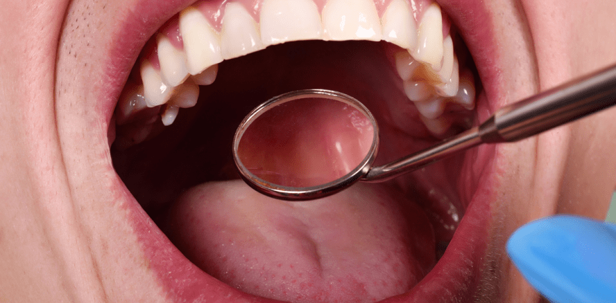 Laser soll Mundkrebsdiagnose ermöglichen