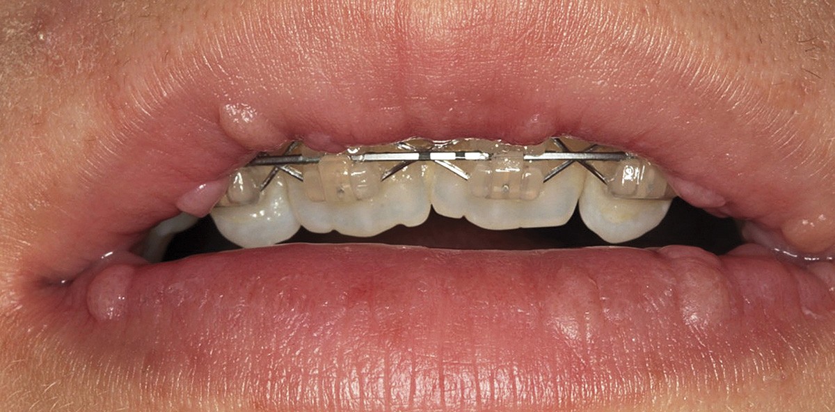 Erkrankungen mit Beteiligung der Mundschleimhaut bei Kindern - Teil 2