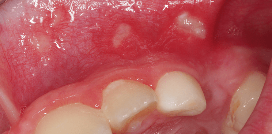 Erkrankungen mit Beteiligung der Mundschleimhaut bei Kindern – Teil 1