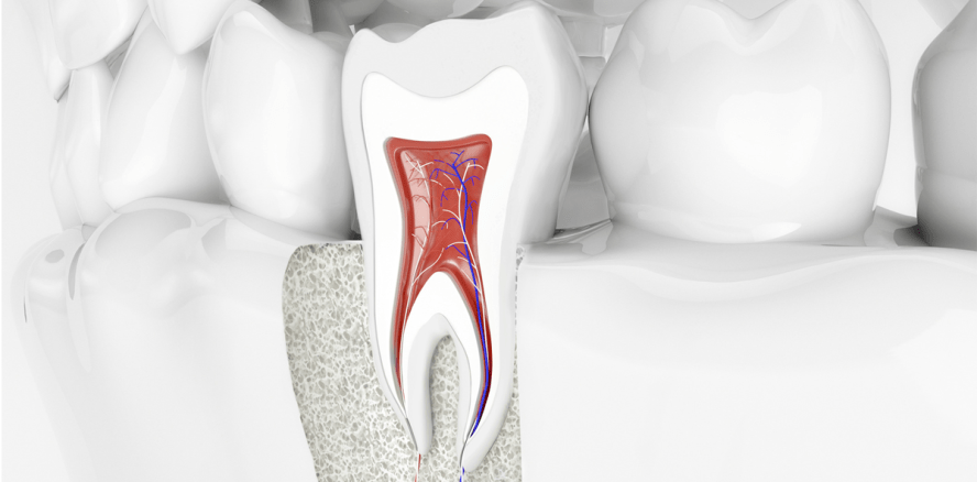 Nanodiamanten verhindern Zahnverlust nach Wurzelbehandlung