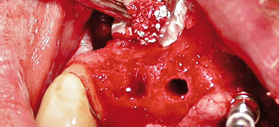 Das Nasenbodenlifting in der enossalen Implantologie