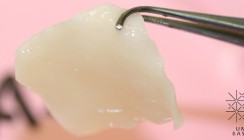 Erstmals Nasenflügel mit gezüchtetem Gewebe rekonstruiert
