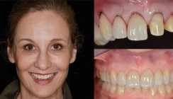 Nature's Design – Neue Zähne ohne künstliche Nebenwirkungen