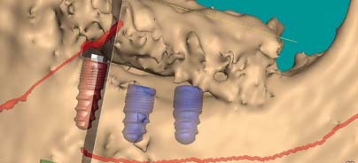 Schablonengestützte navigierte ­Implantation – Freiheit oder Übertherapie?