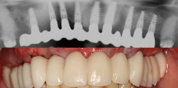 Der ältere Mensch – die navigierte Chirurgie