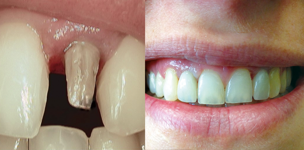 Bereits zehn Prozent der Patienten vertragen Titan nicht