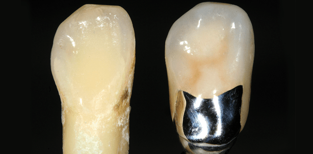 Implantatgetragene NEM-Einzelkrone – Natur trifft Restauration