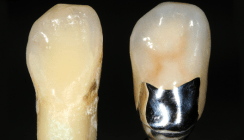 Implantatgetragene NEM-Einzelkrone – Natur trifft Restauration