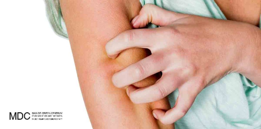 Zehn neue genetische Risikoregionen für Neurodermitis entdeckt