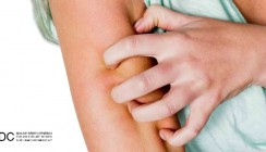 Zehn neue genetische Risikoregionen für Neurodermitis entdeckt