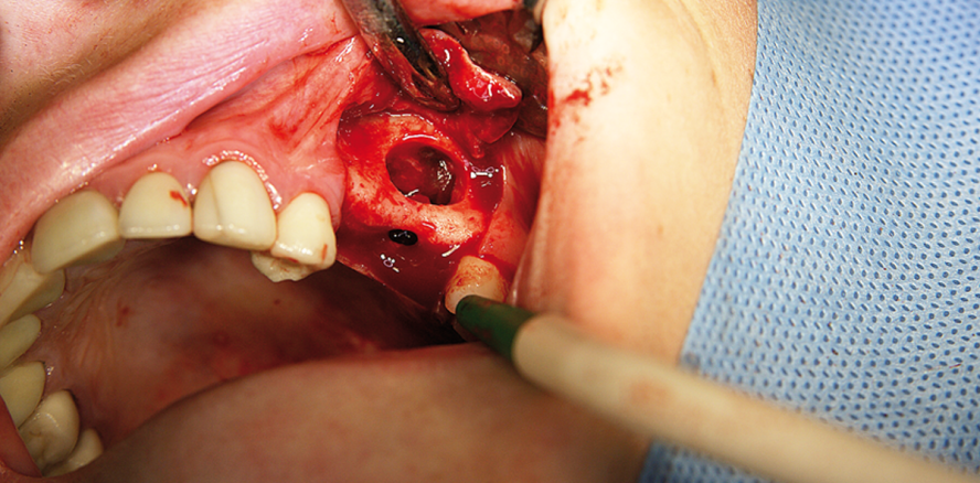 Komplikationsvermeidung im Risikobereich