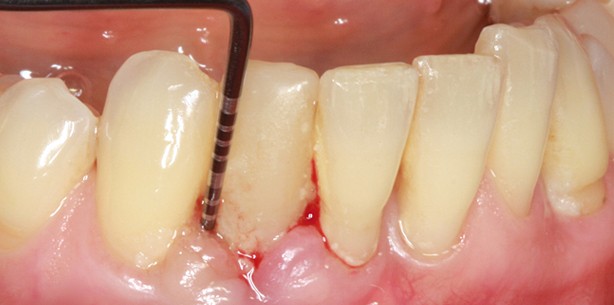 Nichtchirurgische Parodontitis- und Periimplantitistherapie