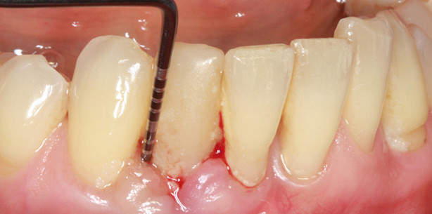 Nichtchirurgische Parodontitis- und Periimplantitistherapie