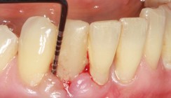 Nichtchirurgische Parodontitis- und Periimplantitistherapie