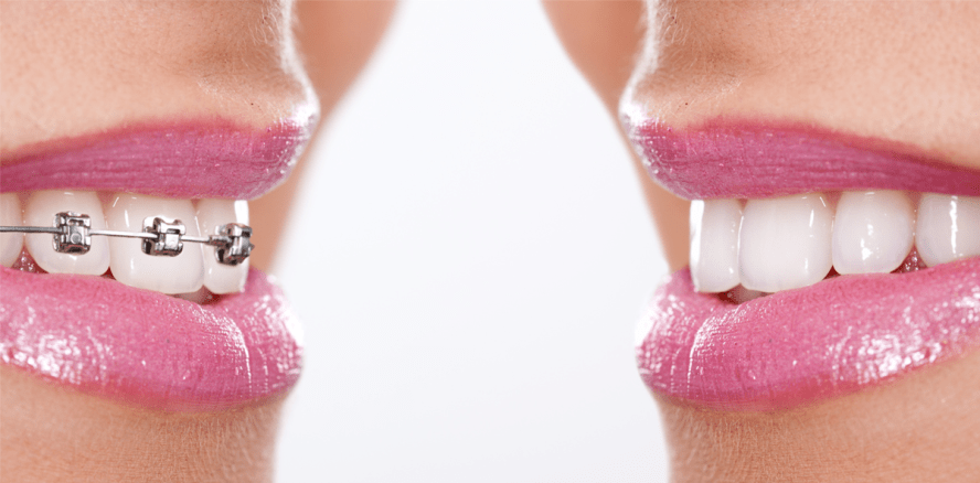 Zahnspangen: Nickel verursacht selten Allergien im Mund